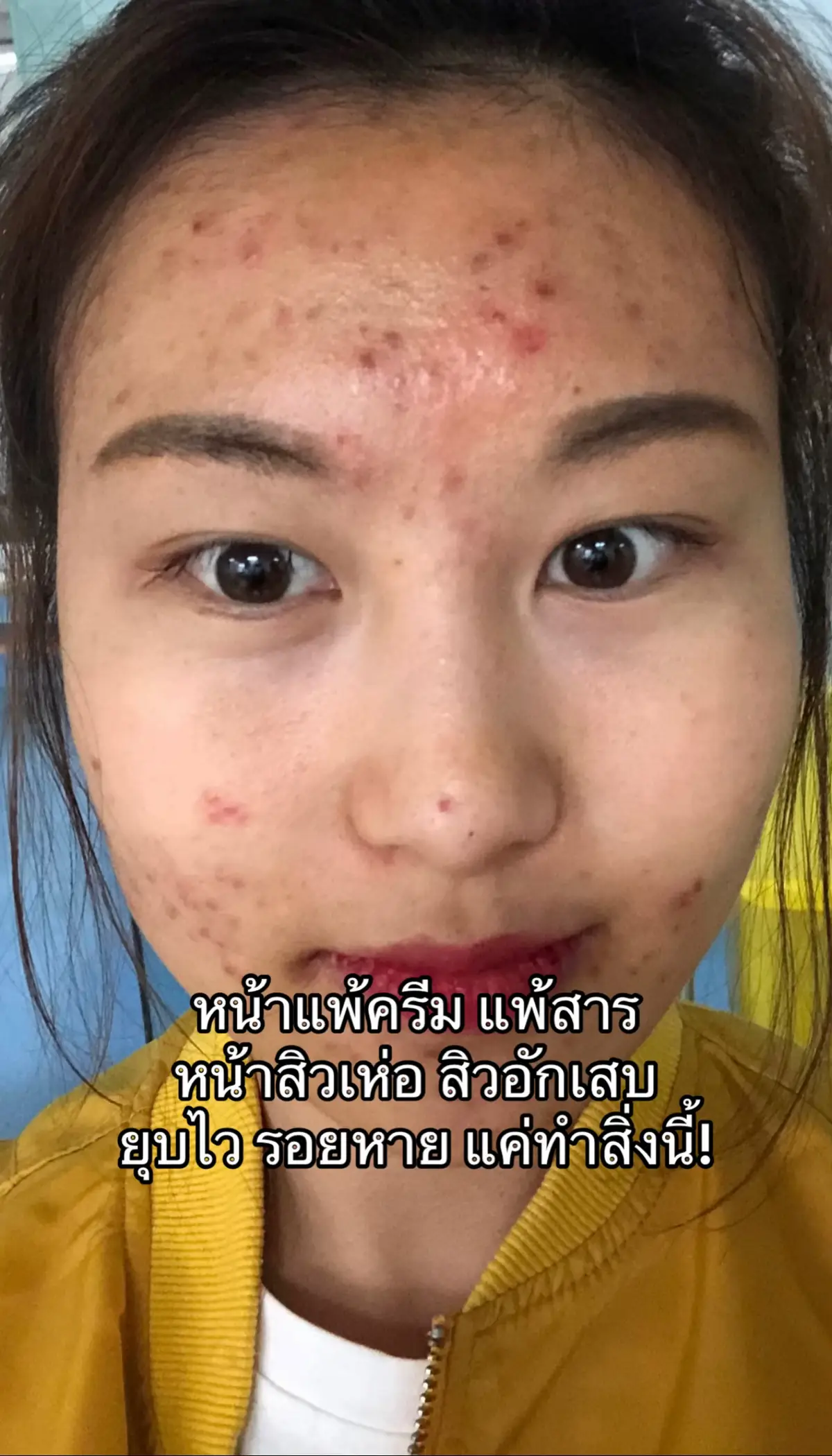#ใช้ดีบอกต่อ #หน้าใสไร้สิว #คอลลาเจน 