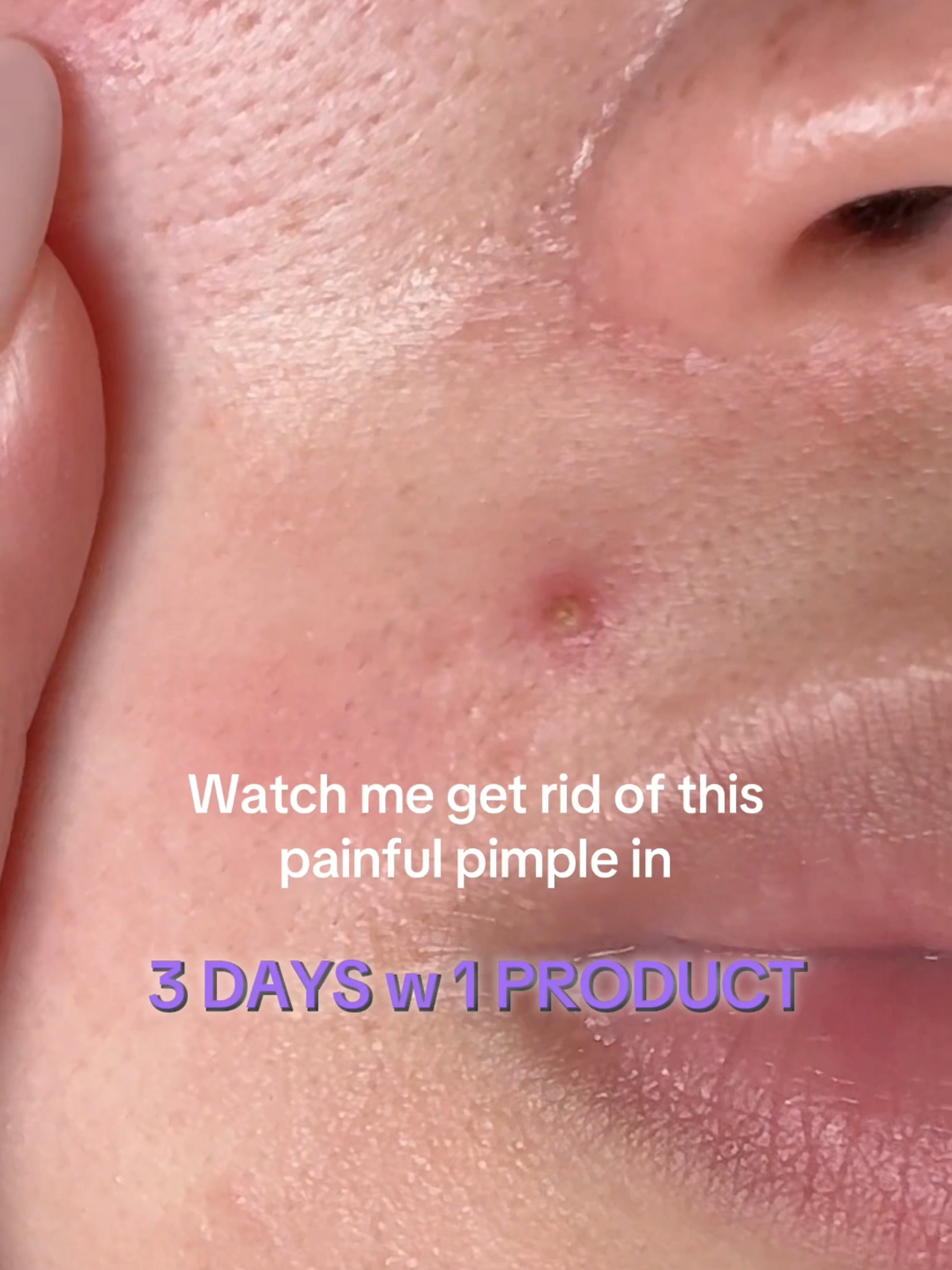 Watch our Benzac AC Mild Strength 2.5% Acne Gel work it's magic 🪄✨ this targeted spot treatment kills up to 94% of acne-causing bacteria (1-2)! 💜 @connaybunnay ALWAYS READ THE LABEL AND FOLLOW THE DIRECTIONS FOR USE. Benzac AC is indicated in the treatment of mild acne. 1. Galderma Data on File. R Jackson, Report no. 88-0740-74 June 1989. Funded by Owen/Allercreme. 2. Mills OH et al. Int J. Dermatol 1986;12(25):664-667. AU-BZC-2500006 #BenzacAU #SkinCare #SkincareEssentials