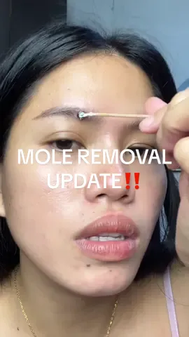 mole removal update!☺️ #moleremovaltreatment #kasoycream #kasoycreamwarts #moleremoval 