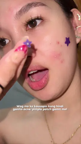 Excuse me po sa mga kumakain. 🤭 #pimplepatch #acnepatch #quaterepimplepatches #fyp 