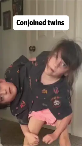 Conjoined twins #daughter #sisters #twins