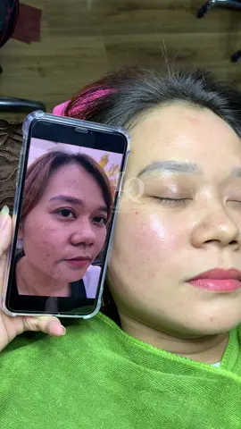 Cập nhật Mụn Thâm Lcl To#chamsocdaseo#chamsocda#chamsocdamun#chamsocdanam#tanbinh#govap #Lequynh#Lqspa#hocnghespa  #chamsocda #lequynhspa #vienthammylqspa #nanmunbangtay #nanmunbangtambong #nanmunbangcay#goidauduongsinh