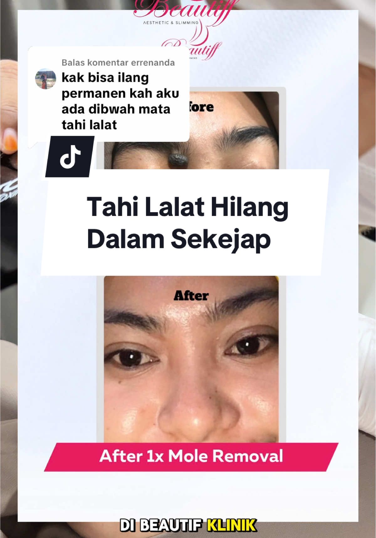 Membalas @errenanda  Tahi lalat hilang dalam hitungan menit, minim rasa sakit! Yes, di Beautiff Clinic kamu bisa treatment mole removal yang cepat dan nyaman✨ Prosesnya aman, ditangani langsung oleh dokter, dan hasilnya bikin kamu lebih percaya diri tanpa ganggu penampilan 💫 🎯 Minim downtime 🎯 Minim rasa sakit 🎯 Hasil lebih bersih dan rapi Yuk konsultasi dulu, biar tahu solusi terbaik buat kamu! 🥰✨ #klinikkecantikan #moleremoval #moleremovalsidoarjo #klinikkecantikanesidoarjo 