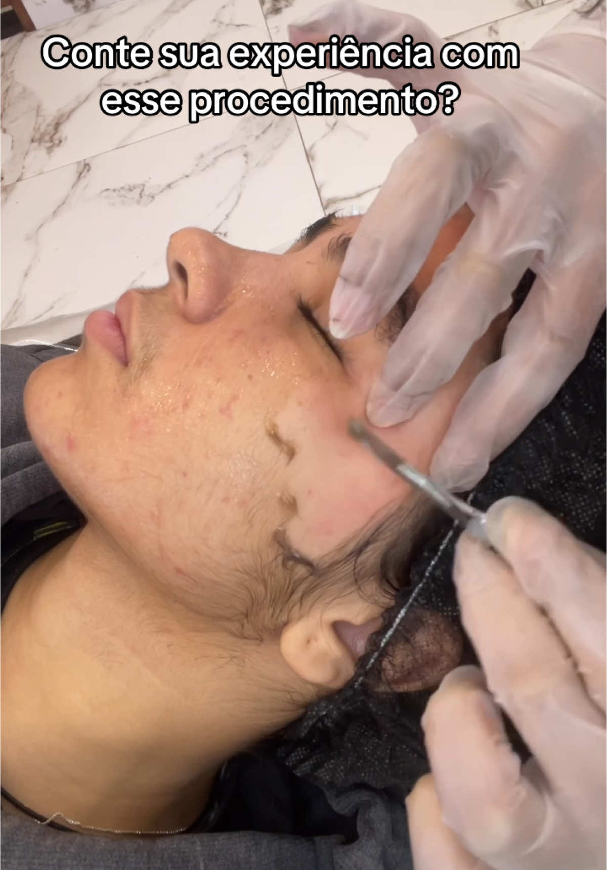 Dermaplaning é um procedimento estético que utiliza uma lâmina afiada, similar a um bisturi, para remover as células mortas da camada superficial da pele e os pelos faciais. O objetivo é promover uma pele mais suave, luminosa e uniforme, além de facilitar a absorção de produtos para a pele #beauty #esteticafacial #estetica #limpezadepele #facial #beleza 