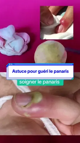 Astuce pour guéri le panaris #onthisday 