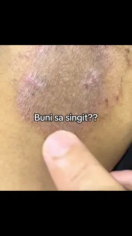 #fyp #herbal #fungalinfection #skinallergy #ointment #akiika #skinproblem 