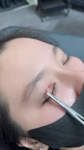 Lại là mí nhấn ạ #nhấnmi #thudaumot #filler 