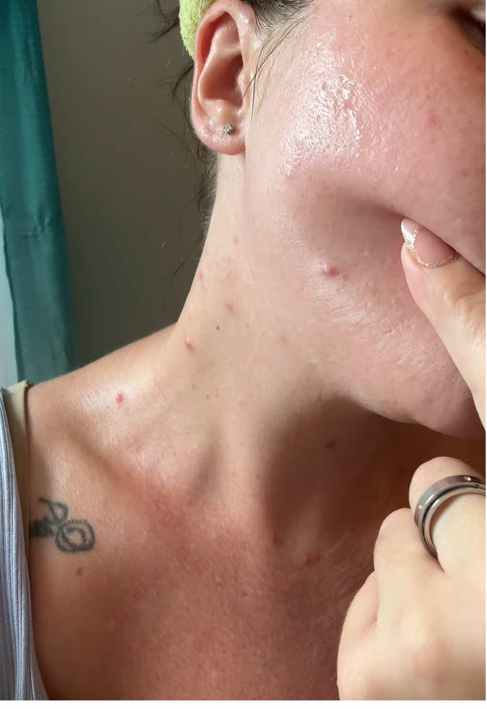 Acne clearing recommendations  pleaseeee #acne #acneproneskin #acnerecommendations #skincarerecommendations #pleasehelp 