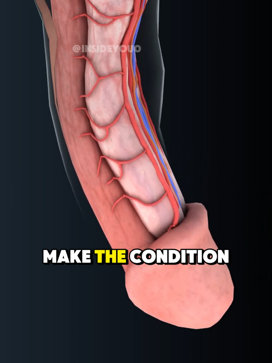 5 Foods That May Worsen Peyronie’s Disease #peyroniesdisease #PeyroniesDiet #peyroniesawareness #peyroniestreatment #peyroniescare #MensHealthPeyronies 