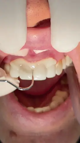 Zirconium crowns and bridges to protect root canal treated teeth #dentist #dental #dentistry 