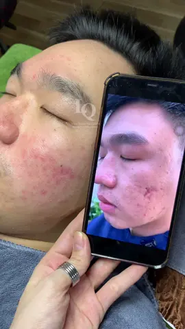 Cập nhật Da Sẹo#chamsocdaseo#chamsocda#chamsocdamun#chamsocdanam#tanbinh#govap #Lequynh#Lqspa#hocnghespa  #chamsocda #lequynhspa #vienthammylqspa #nanmunbangtay #nanmunbangtambong #nanmunbangcay#goidauduongsinh