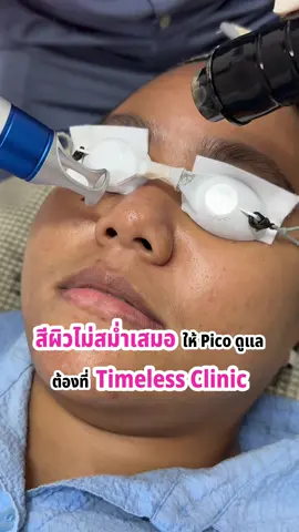 สีผิวไม่สม่ำเสมอ ให้Pico Laser ดูแล ต้อง Timeless Clinic จ่ายไม่ถึงหมื่น ทำได้ 20 ครั้ง จุกๆ 💖 #TimelessClinic #timelessไม่มีเซลล์ไม่มีขายคอร์สล่วงหน้า #เรื่องหน้าใสไว้ใจtimeless #picolaser 