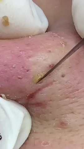 #spa #beautify #squeezingpimples #skincare #asmr 