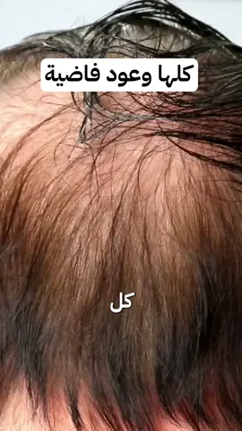حافظ علي فروة راسك