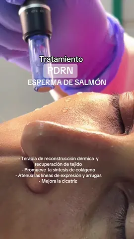 PDRN Esperma de Salmón TRATAMIENTO EN JELI CENTRO DE ESTÉTICA INTEGRATIVA: Experto regenerador, disminuye manchas, atenúa arrugas y flacidez. Es un biomodulador que estimula la regeneración celular y mejora la calidad de la piel. También conocido como PDRN, por sus siglas en inglés: Polydeoxyribonucleotide. Beneficios ✅ Regeneración celular: Promueve la reparación del tejido dañado y estimula la ✅ proliferación de fibroblastos. ✅ Aumento del colágeno: Mejora la elasticidad y densidad dérmica. ✅ Hidratación profunda: Ayuda a mejorar la hidratación y la textura de la piel. ✅ Efecto antiinflamatorio: Reduce la inflamación y puede usarse en pieles sensibles o con rosácea. ✅ Luminosidad y tono uniforme: Aporta un aspecto más joven y saludable ¿QUÉ TIEMPO TOMA? TOMA  60 minutos.  Nuestros horarios son: Lunes a viernes 09:00 a 13:00 y 15:00 a 19:00 Sábados: 09:00 a 14:00  Tenemos 10 minutos de tolerancia y contamos con Qr de RESERVA 😌 🏥Dirección: San Miguel, Calle Enrique Peñaranda, y Claudio Aliaga Nro 1258,   CELULAR: 77908728📱 #pdrn #espermadesalmon #RejuvenecimientoFacial #cuidadodelapiel #cuidadofacial #jelicentroesteticaintegrativa