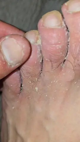 Happy Tuesday #foot #fungus #athletefoot #itchy #tuesday 