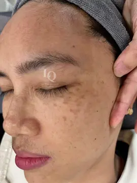 Cập Nhật Da Nám Đinh#chamsocdamun#chamsocdanam#chamsocseo#lequynhspa#hocnghespa#nanmunbangtambong#nanmunbangtay