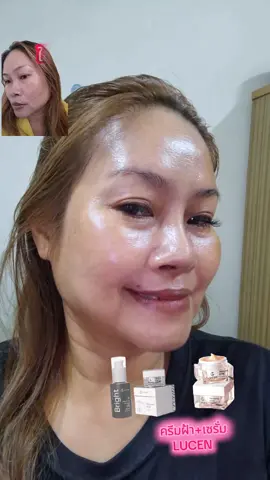 ผลลัพท์ของครีมฝ้าหน้าเงาลูเซน ระยะเวลา6เดือน#ลูเซน #LUCEN #ครีมลูเซน #เซรั่มฝ้าลูเซน 