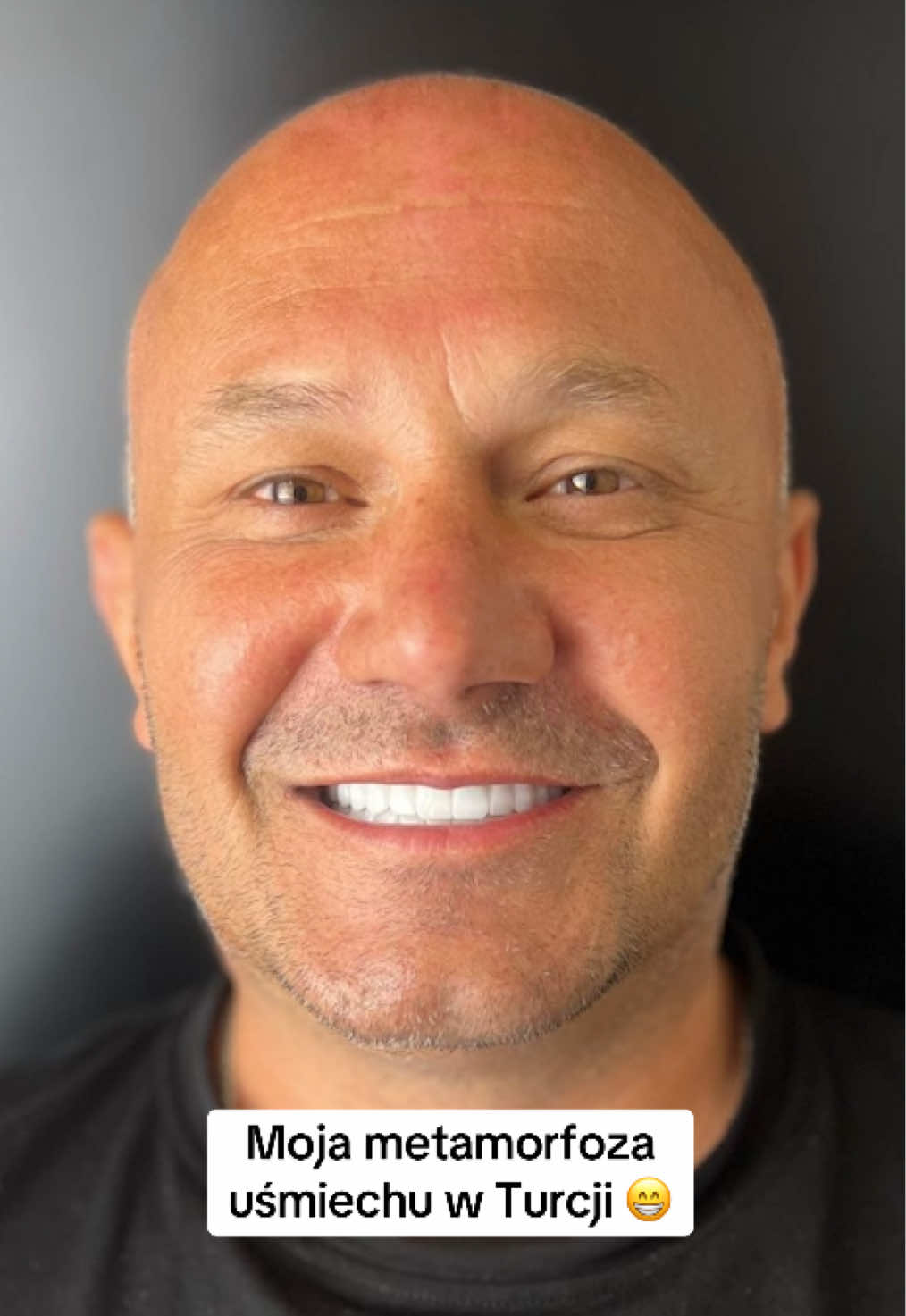 Przeszedłem metamorfozę mojego uśmiechu w Turcji! #metamorfoza #GlowUp #hollywoodsmile #smile #teeth #zębywturcji 