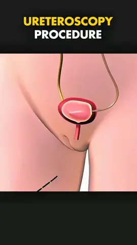 ureteroscopy procedure. Medical 3d Animations.