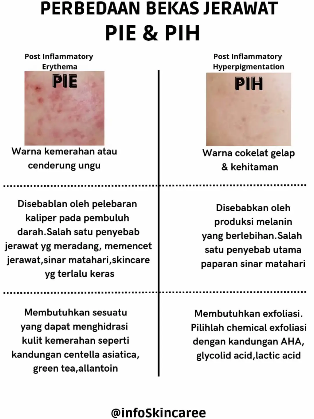 #darkspot #bekasjerawat #nodahitam #skincareroutine 