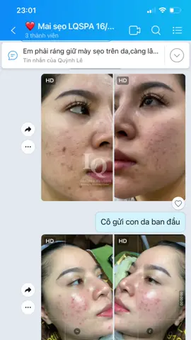 Cập nhật Da Sẹo#chamsocdamun#chamsocdanam#chamsocdaseo#lequynhspa#hocnghespa#nanmunbangtay#nanmunbangtambong 