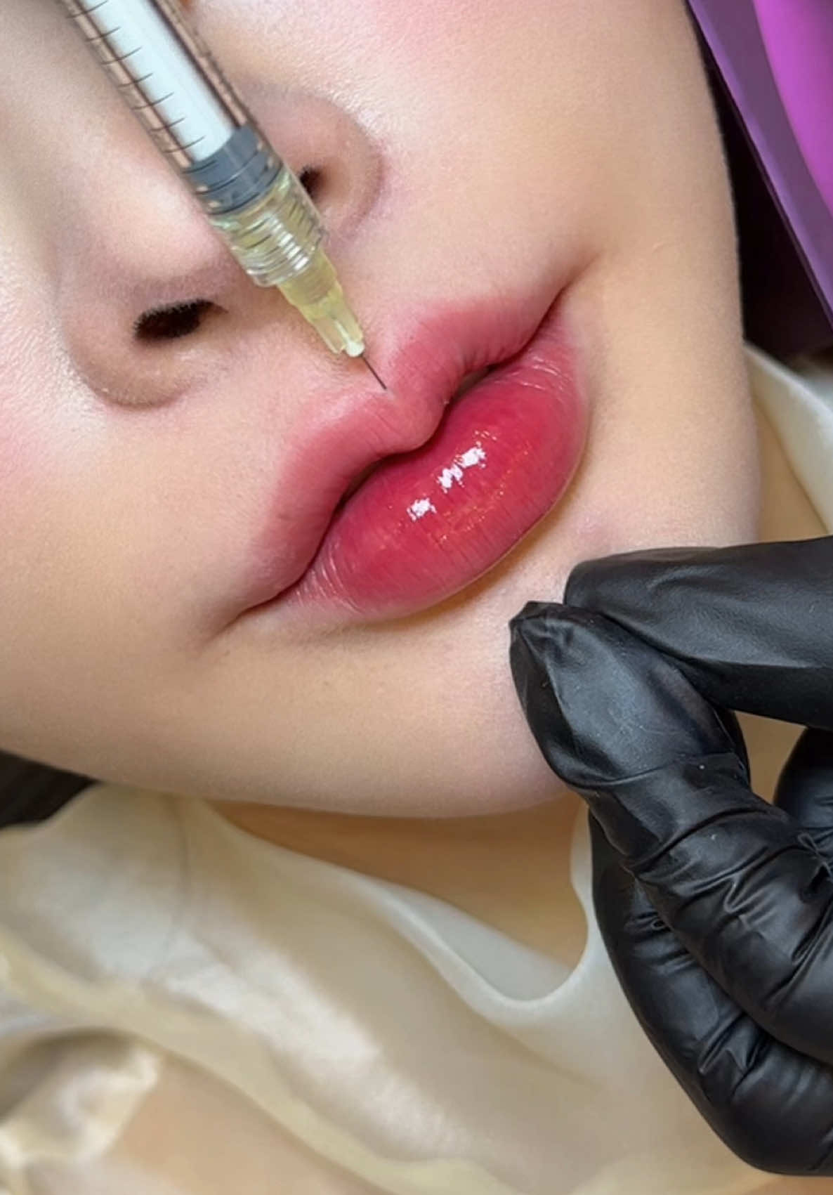 Đu trend tổng tài là phải flex Môi Juvederm💜 #tiemmoi #juvederm 