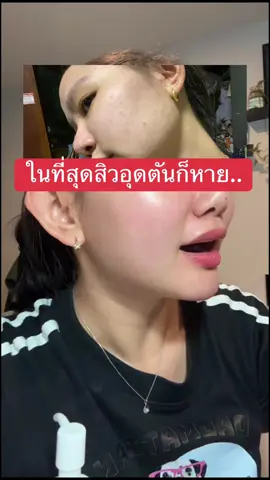 หายจริงแบบดีใจอ่าาา  #รีวิวของดีบอกต่อ #ของดีบอกต่อ #สิวอุดตัน #เลอโฉม #lechom #เจลล้างหน้า #เซรั่มล้างหน้า 
