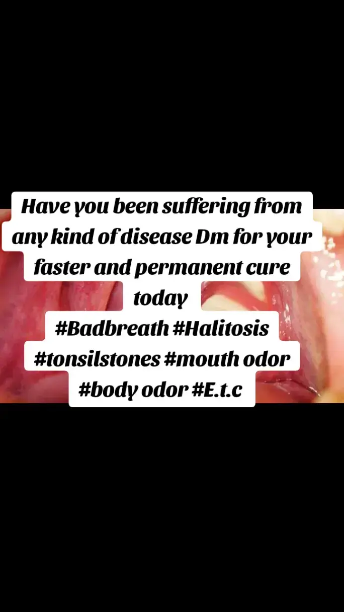 Have you been suffering from any kind of disease Dm for your faster and permanent cure today  #Badbreath #Halitosis #tonsilstones #mouth odor #body odor #effective #oralprrobiotics #Herbal #E.t.c#goviral 