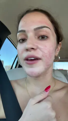 Yall everytime I step outside I look insane #help #skin 