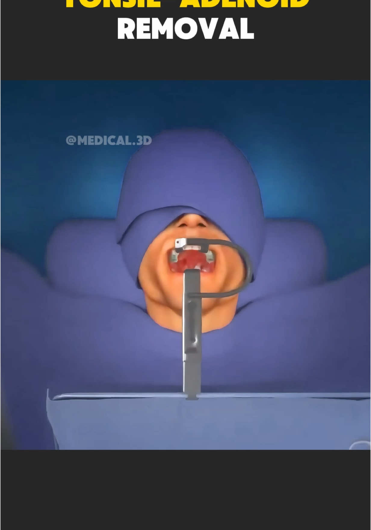Tonsil and Adenoid Removal Surgery (Adenotonsillectomy) #adenotonsillectomy #adenotonsillotomy #tonsillectomy #tonsillectomyrecovery #tonsillectomyrecoverytips #tonsils #tonsillitis #medical3danimation #3dmedicalanimation 