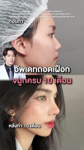อัพเดทหลังถอดเฝือก จมูกครบ 10 เดือนแค่เสริมจมูกก็เพิ่มมิติใบหน้าเพราะออกแบบตามหลัก Golden Ratio ละมุนมากค่ะ #emmaclinic #ลูกสาวหมอภัทร #EMMAจองจ่ายจบ #ทรงteardrop #จมูกทรงสวย #ทำจมูกemmaclinic#ทําจมูกemmaclinicทรงหยดน้ำ#ทรงหยดน้ํา #emmaclinicเสริมจมูก