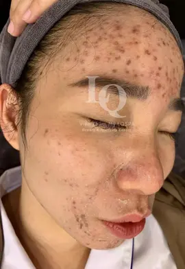 Cập nhật Da Mụn Thâm#chamsocdamun#chamsocdanam#chamsocseo#lequynhspa#nanmunbangtay#nanmunbangtambong#hocnghespa