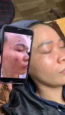 Cập nhật Da Mụn#chamsocdaseo#chamsocda#chamsocdamun#chamsocdanam#tanbinh#govap #Lequynh#Lqspa#hocnghespa  #chamsocda #lequynhspa #vienthammylqspa #nanmunbangtay #nanmunbangtambong #nanmunbangcay#goidauduongsinh