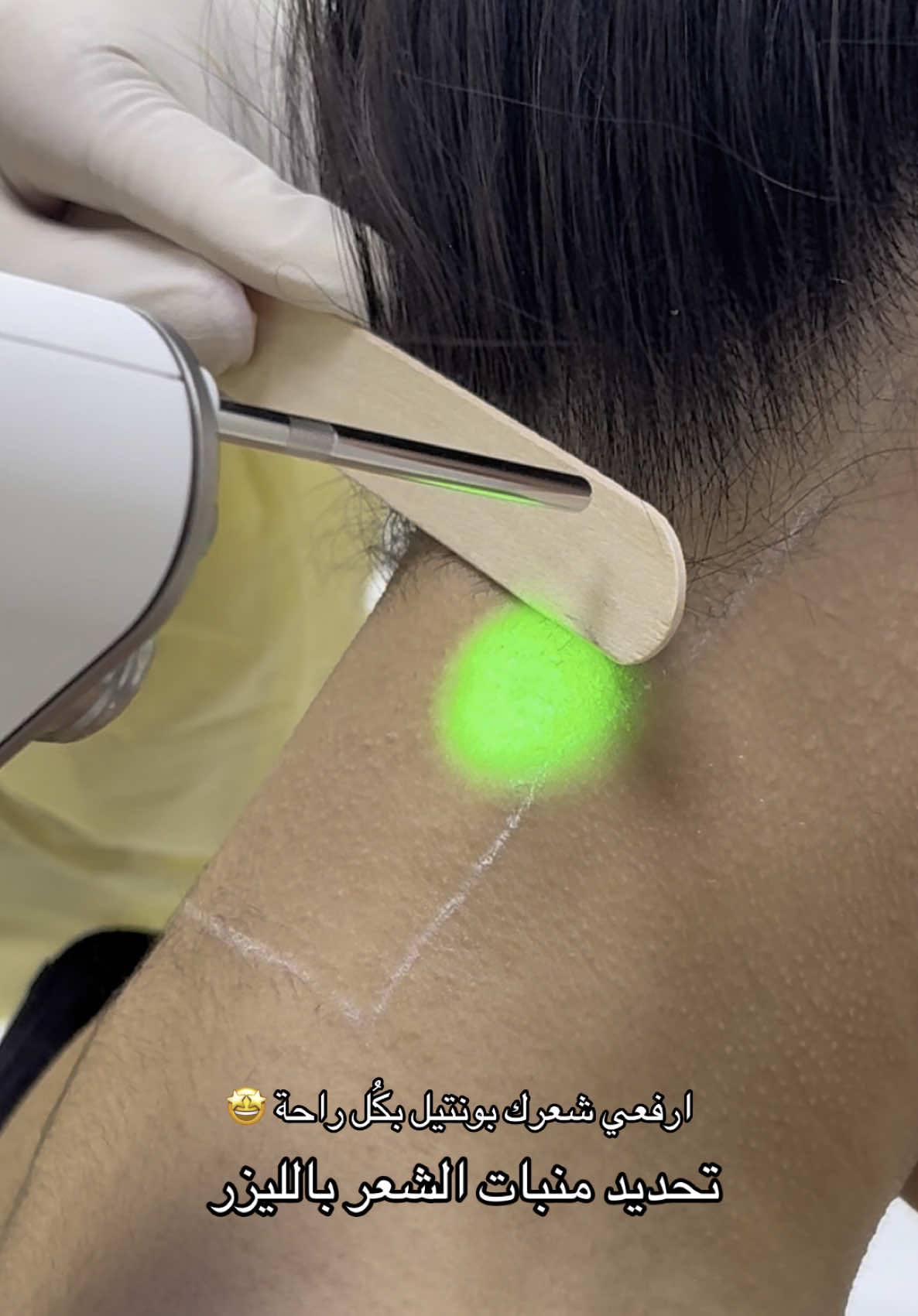 #ليزر_شعر #ليزر_جسم #ليزر_فوتونا #ليزر_ديكا #fyp #ترند #تحديد_الشعر 