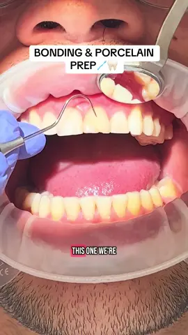 Ever wonder what’s happening in your mouth during treatment? Come along with @Dr Bridget | NYC Dentist for an appointment! 🪥🦷 #compositebonding #porcelainveneers #cosmeticdentistry #maisonbedental 