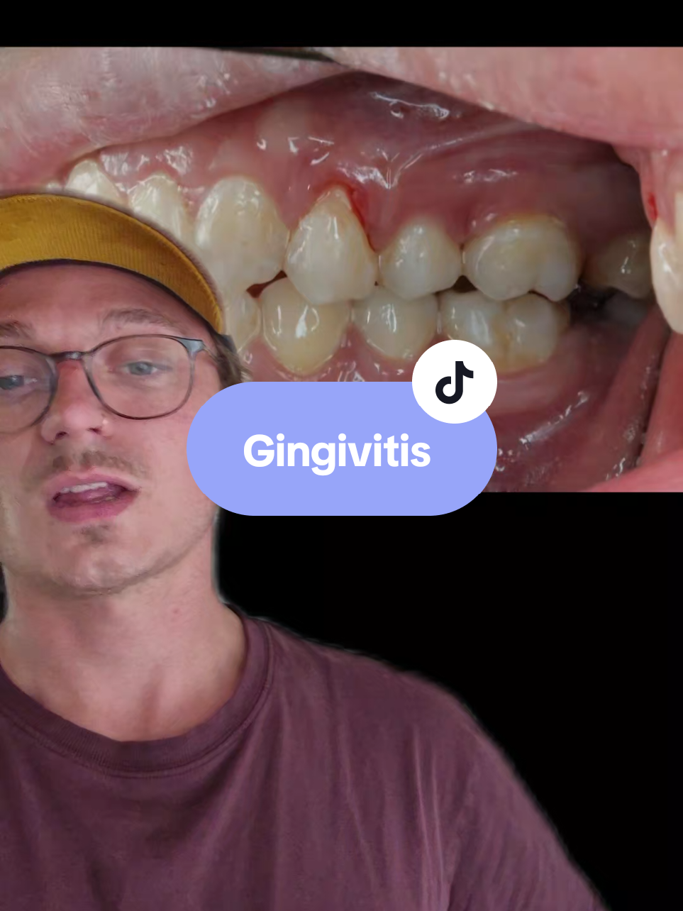 #greenscreen Gingivitis starts at the gumline, not the tooth. Brush smarter, not harder. 🧠🪥 #BrushYourGums #oralhacks  #gingivitis #periodontitis 