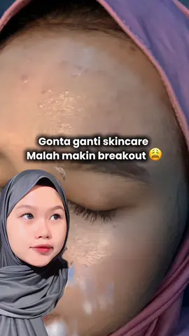 Gonta ganti skincare malah makin breakout untung nya nemuin basic skincare yg gong bgt dari acneno 🫶🏻🥰 #testimurniacneno #acneno 