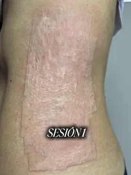 ¡Dile adiós a las cicatrices y hola a una piel renovada con Láser CO2! Este tratamiento avanzado trabaja estimulando la producción de colágeno nuevo en tu piel, rellenando las depresiones y suavizando la textura de las cicatrices desde adentro. ¡Contáctanos hoy mismo para agendar tu consulta! #cicatrices #adioscicatrices #laserco2 #pielrenovada #caracas #fyp