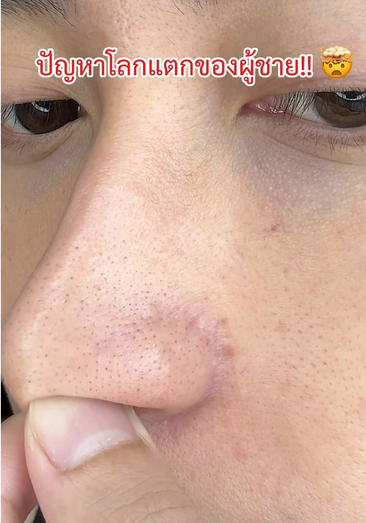 ปัญหาโลกแตกอะ พวกสิวหัวดำ รูขุมขน #มาร์คแดง #เซรั่มผลัดเซลล์ผิว #มาส์กแดงSkintific
