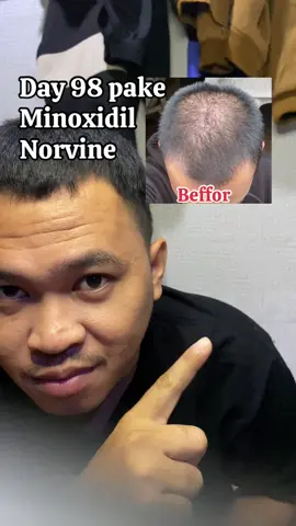 #penumbuhrambut #minoxidil #perawatanrambut #genetik #dht #fypage #minoxidilkirkland #hairoil #makarizo #sawpalmetto #norvine 