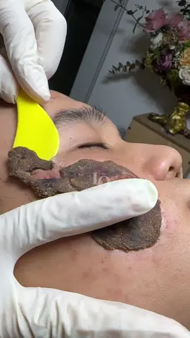 Đắp đầy#chamsocdaseo#chamsocda#chamsocdamun#chamsocdanam#tanbinh#govap #Lequynh#Lqspa#hocnghespa  #chamsocda #lequynhspa #vienthammylqspa #nanmunbangtay #nanmunbangtambong #nanmunbangcay#goidauduongsinh