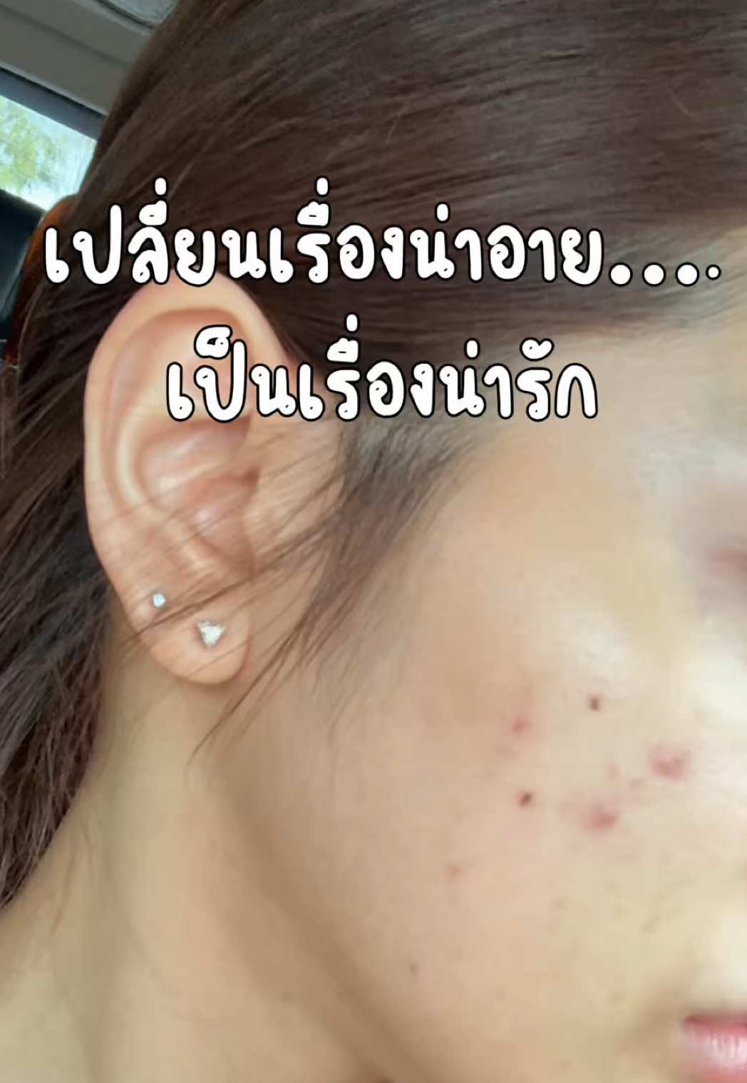 เปลี่ยนเรื่องน่าอายให้เป็นเรื่องน่ารัก ด้วยแผ่นแปะสิวแบบติดแกรม 💘 @Beautier TH  #Beautier #BeautierHappier #ใครแปะก็สวย #แปะสวยทุกสีผิว