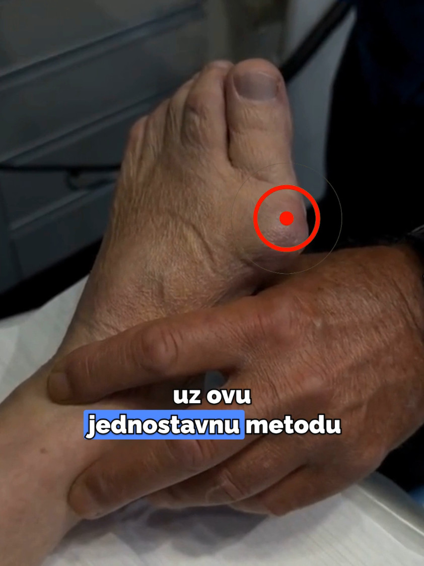 Riješi se čukljeva bez bolne operacije ✨️ #cukljevi #kiroprakticar #ortoped #zdravlje 