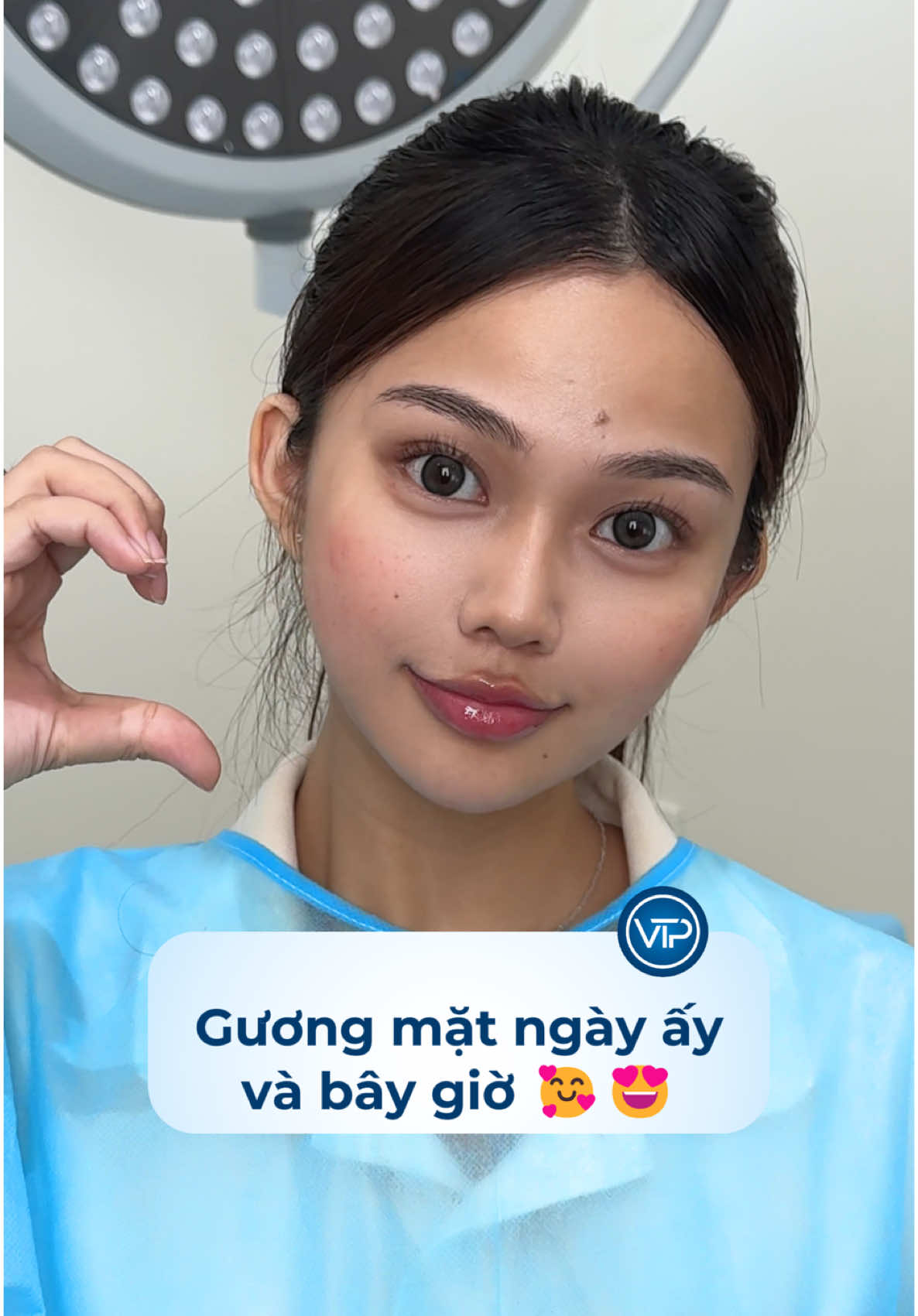 Gương mặt ngày ấy và bây giờ 💯❤️#xuhuong #phungmelamdep #trending #thammy #vuthiphung #dinhcoamino #canchinhfullface 