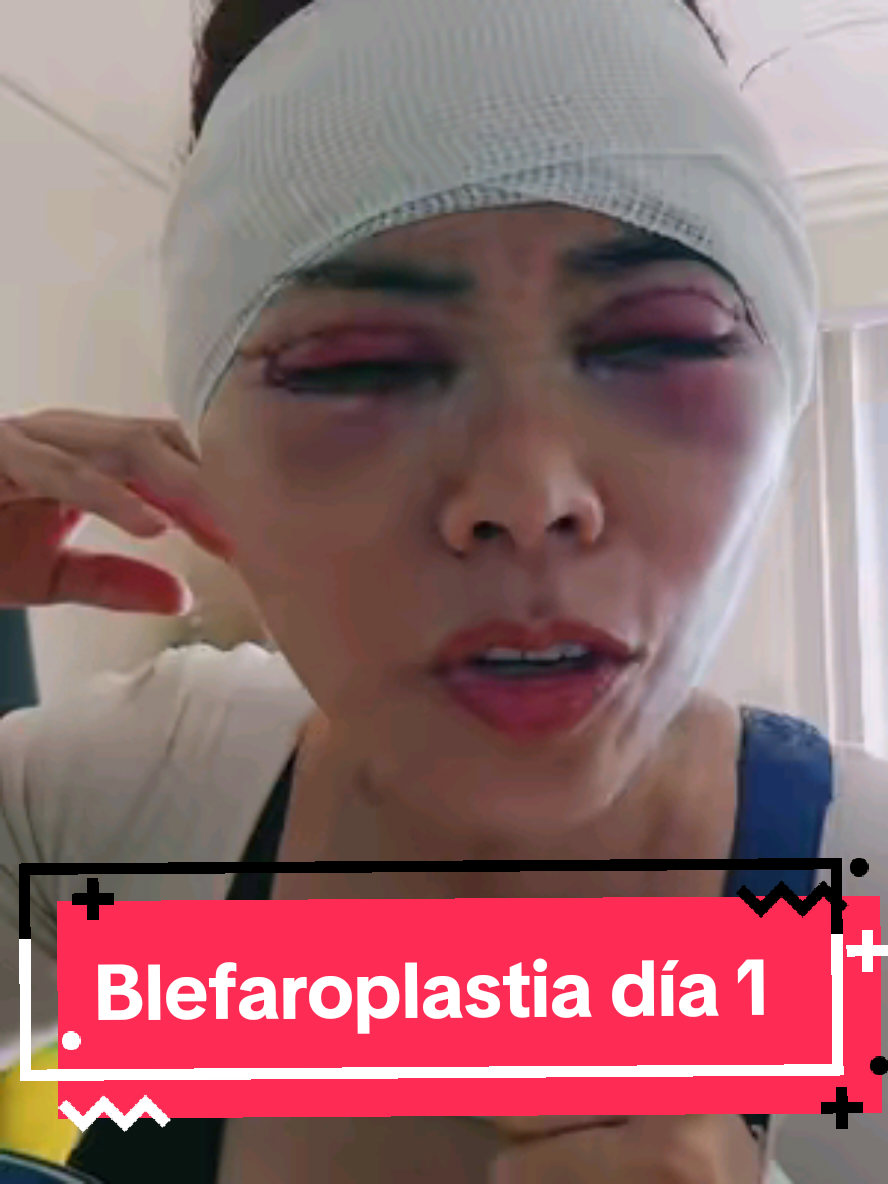 Día 1 #blefaroplastia #levantamientoterciosuperior #mommymakeover #facelift #transformacion #cirugiaplastica 