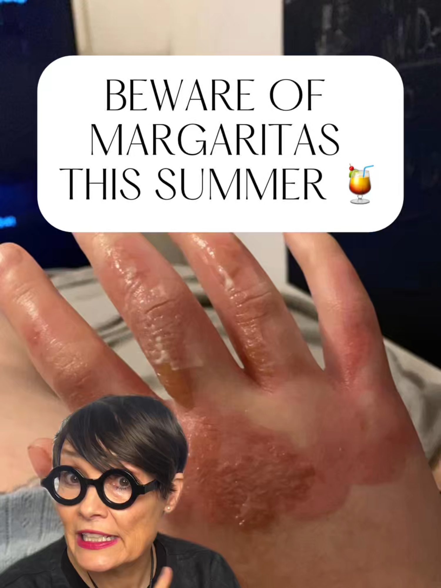 BEWARE of #margaritas this summer!🍹 #hostess #skinburn #margarita #personalhygiene #skintips #margaritaville