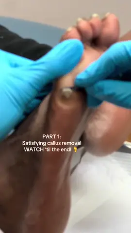 Callus: this is build up of pressure and friction over months of barefoot walking and improper shoe gear. This one is so thick it had layers!! 😳👇 Watch me vote this out! #podiatry #pimplepopper #peel #SelfCare #callusremoval #dermtok #foottok #satisfying #callus #treatment #GlowUpCetaphil 