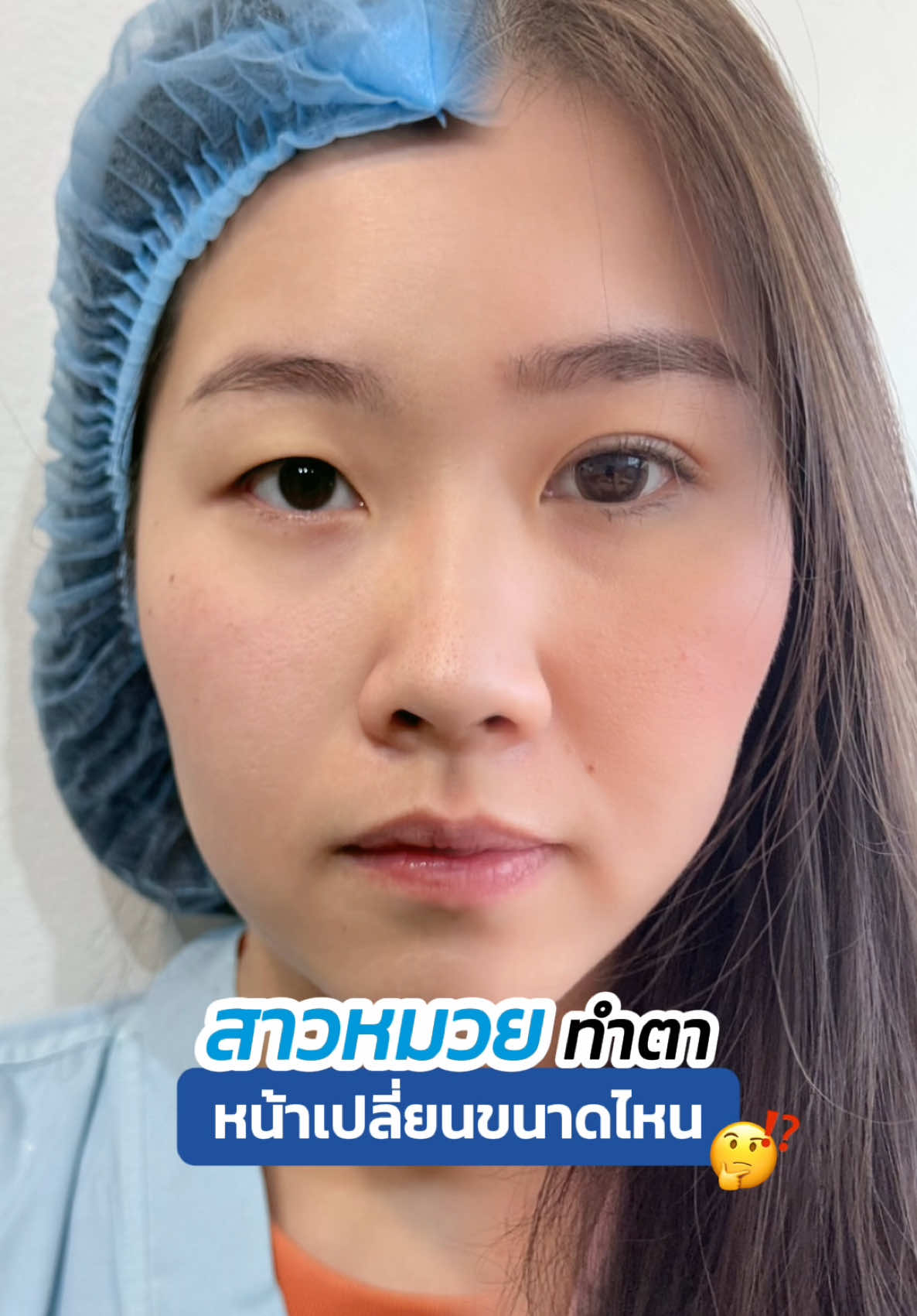สาวหมวยไม่มีชั้นตา ทำตาสองชั้น หน้าจะเปลี่ยนแค่ไหน ✨ #รีวิวตาสองชั้น #skyclinic #จักษุแพทย์ #ทำตาที่ไหนดี #ศัลยกรรมตา #หมอสกาย #สกายคลินิก 