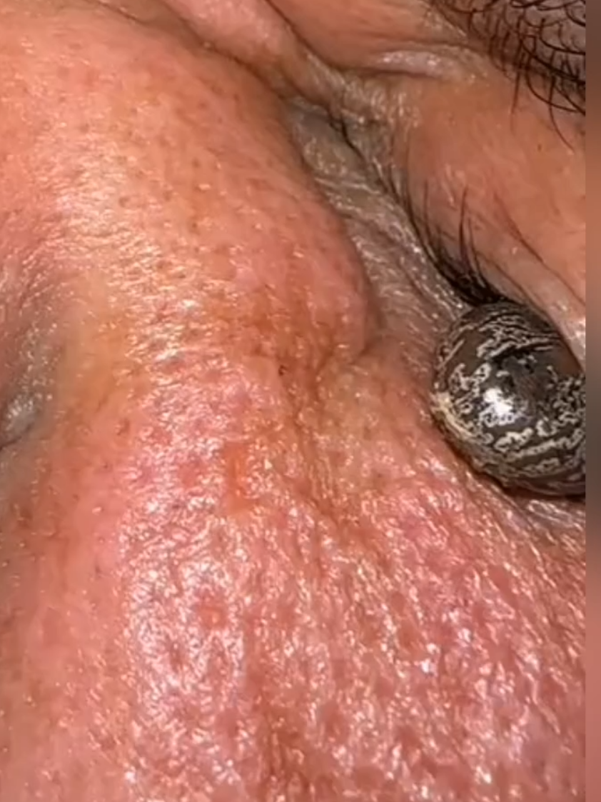 ظَنَّ هذا الرجل أن شيئًا ما عالق في عينه، لكن ما وجدوه كان مذهلا لدرجة أن الطبيب الأكثر خبرة شعر بالصدمة #قصص #قصص_واقعية #طبيب #عيون #عين #اعمى #حشرات #لدغة #رقبة #اكسبلور #الشعب_الصيني_ماله_حل 